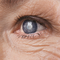 Cataract eye surgery