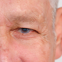 Glaucoma