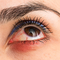 Uveitis
