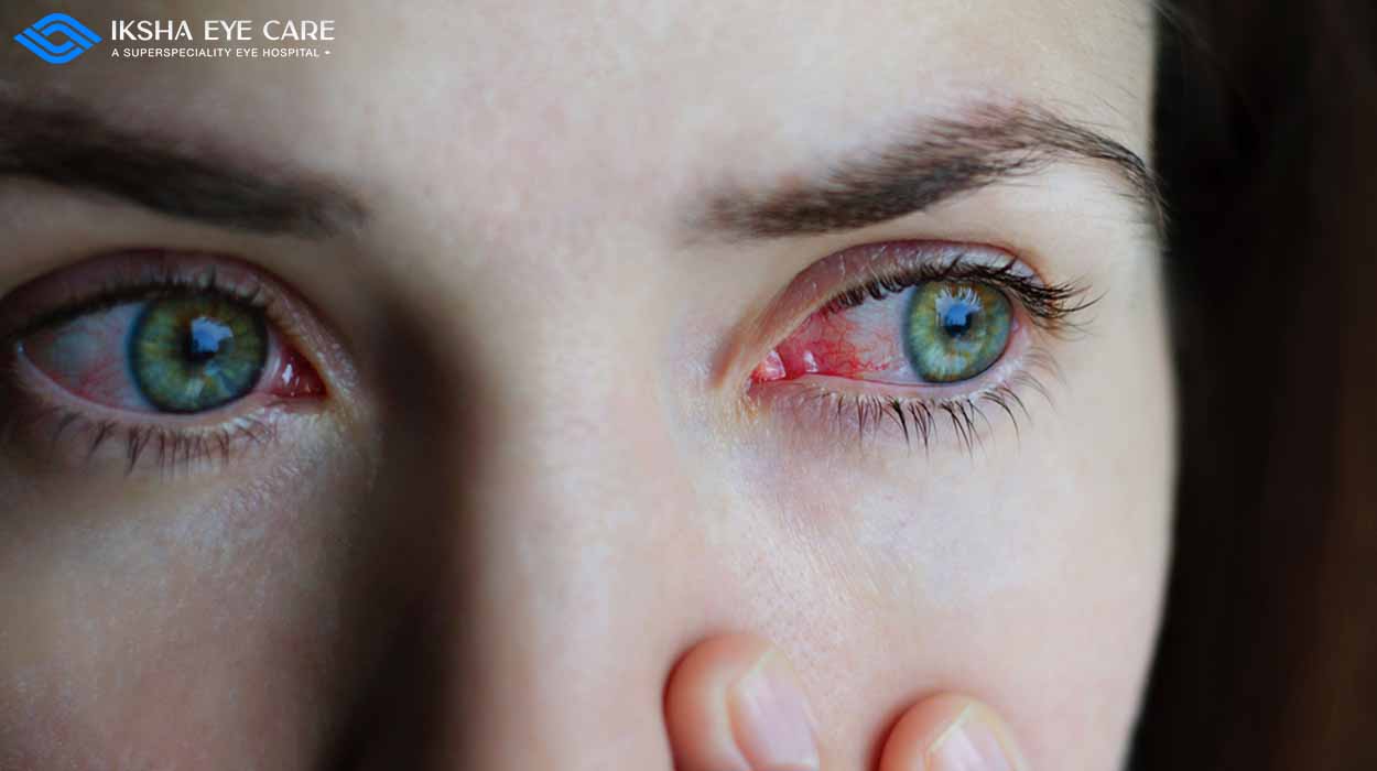 Eye Flu: Symptoms, Prevention, and Tips for Relief During the Current Outbreak